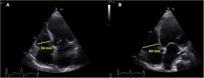 Right ventricular global dysfunction score: a new concept of right ventricular function assessment in patients with heart failure with reduced ejection fraction (HFrEF)